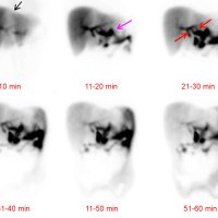 Precise Localization of a Bile Leak with Hepatobiliary Scintigraphy