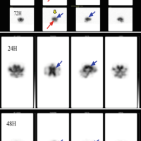 Cerebrospinal Fluid CSF Scintigraphy