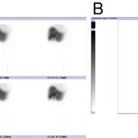The hot rim sign on hepatobiliary scintigraphy HIDA with CT correlation